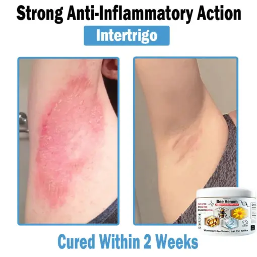 TODAHOF™ Bee Venom Multi-Symptom Skin Treatment Cream