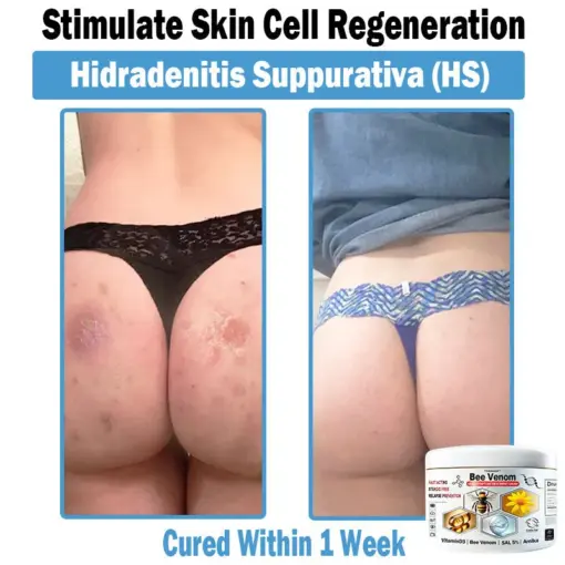 TODAHOF™ Bee Venom Multi-Symptom Skin Treatment Cream