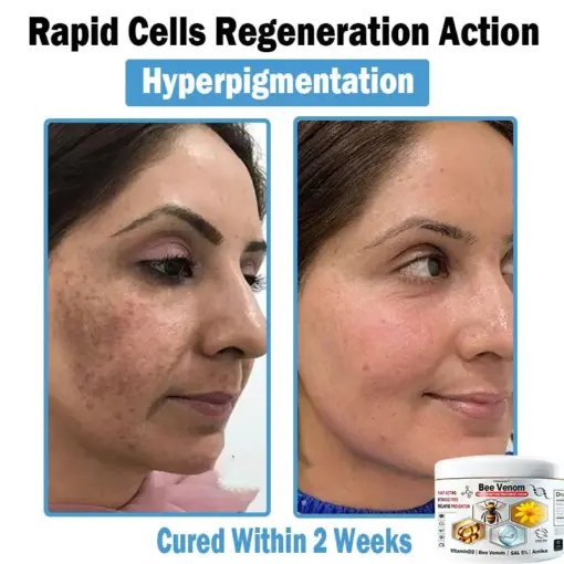 TODAHOF™ Bee Venom Multi-Symptom Skin Treatment Cream