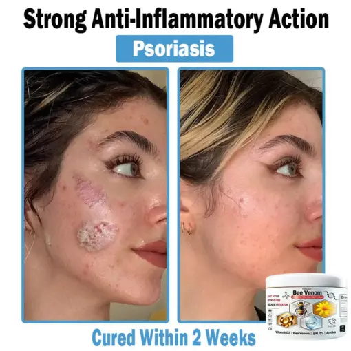 TODAHOF™ Bee Venom Multi-Symptom Skin Treatment Cream