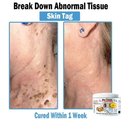 TODAHOF™ Bee Venom Multi-Symptom Skin Treatment Cream