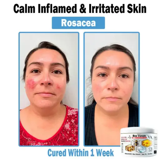 TODAHOF™ Bee Venom Multi-Symptom Skin Treatment Cream