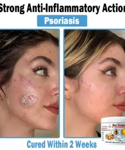 TOD𝑨𝐇OF® 𝑩𝒆𝒆 𝑽𝒆𝒏𝒐𝒎 𝑴𝒖𝒍𝒕𝒊-𝑺𝒚𝒎𝒑𝒕𝒐𝒎 𝑺𝒌𝒊𝒏 𝑻𝒓𝒆𝒂𝒕𝒎𝒆𝒏𝒕 𝑪𝒓𝒆𝒂𝒎